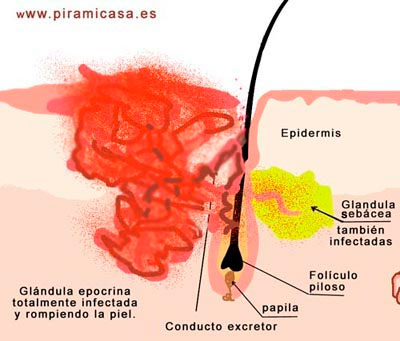 Glándula apocrina infectada por bacterias y rompiendo la piel