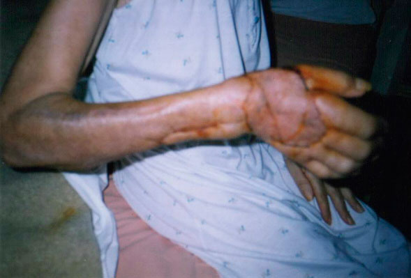 Paciente con mano transplantada