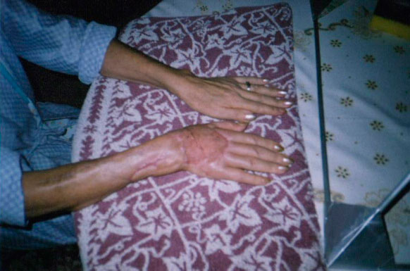 Paciente con mano transplantada tratada con el efecto piramidal