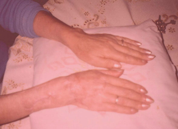 Mano transplantada con muy buen aspecto gracia al efecto piramidal